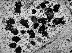 M,17y. | increased amount of lipofuscin in hepatocyte - hyperbilirubinemia, Gilbert or Dubin-Jones syndrome M,17y. | increased amount of lipofuscin in hepatocyte - hyperbilirubinemia, Gilbert or Dubin-Jones syndrome